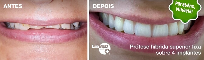 Caso clínico | Mihaela | Prótese híbrida superior fixa sobre 4 implantes