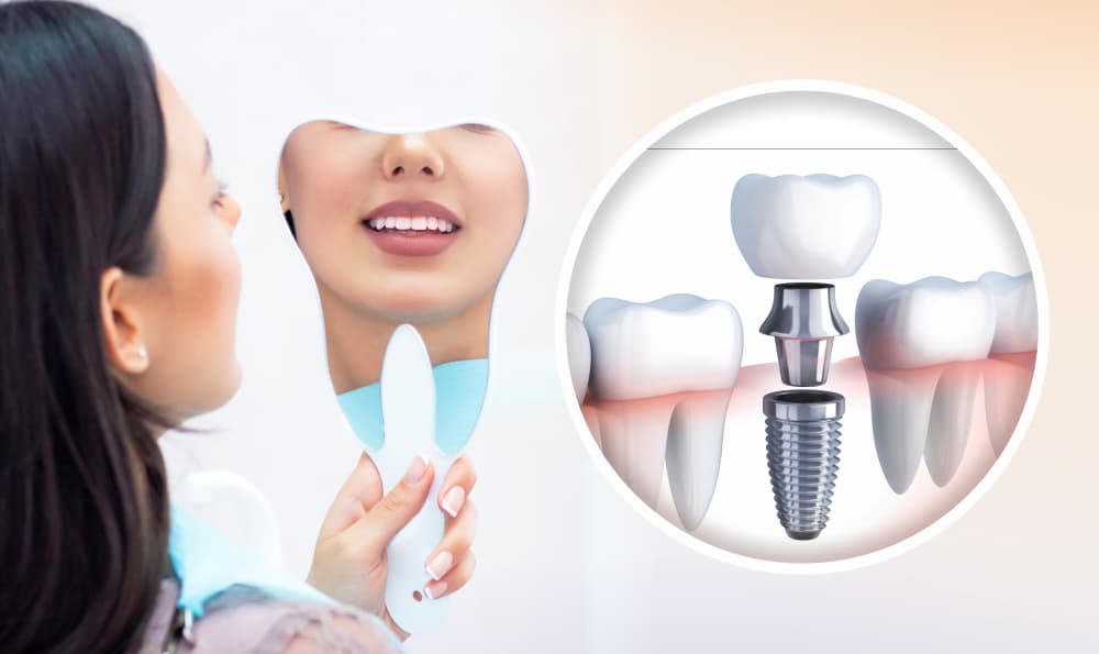 Implante Dentário